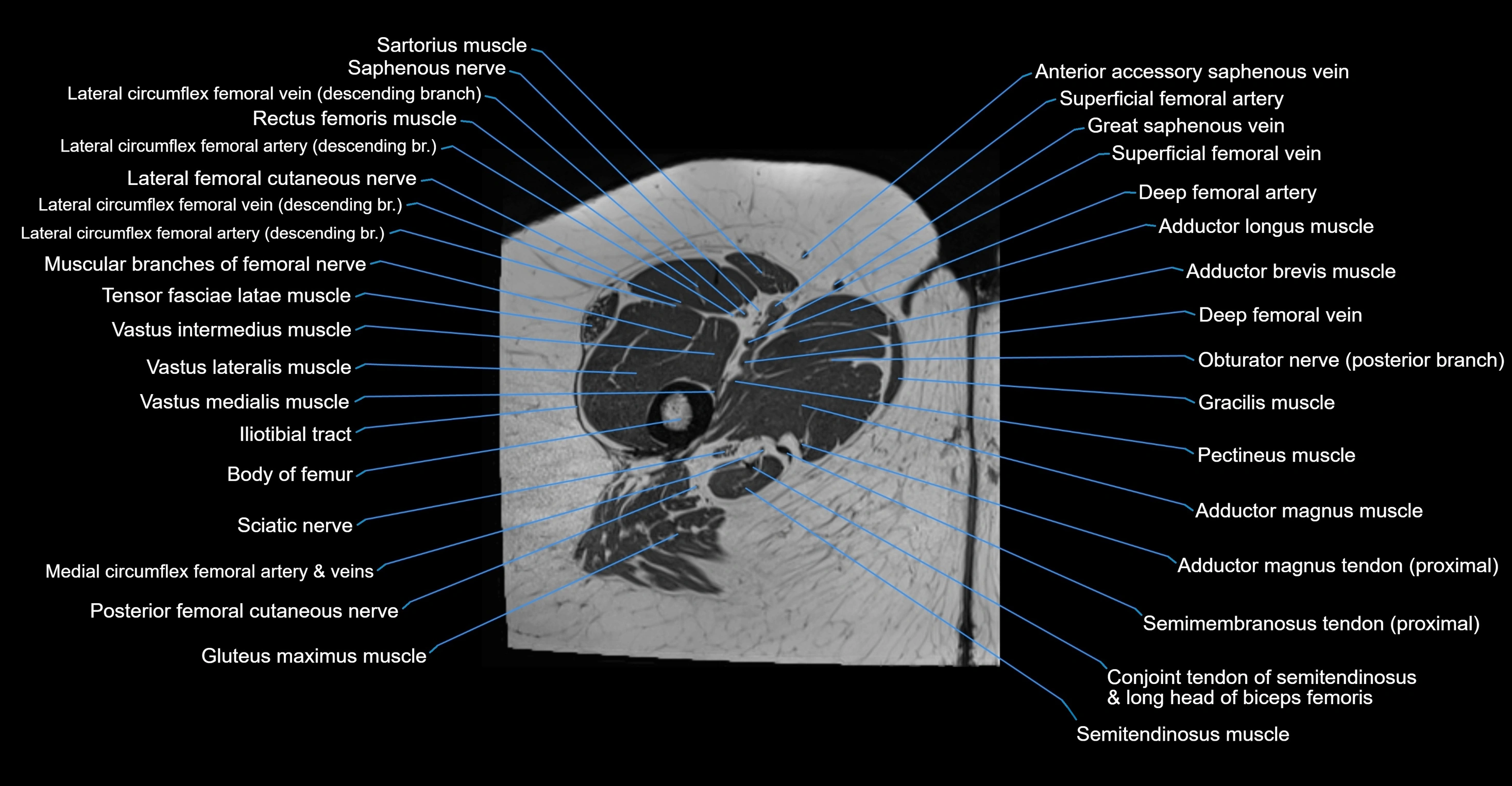 MRI hip axial cross sectional anatomy 3T 3D  radiology  anatomy image-img-00001-00086.webp